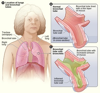 Bronsita cauze tratament